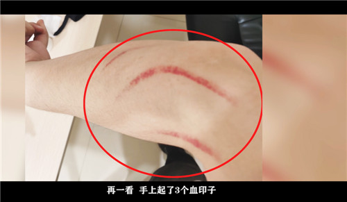 民警处警过程中被艾滋病嫌疑人抓伤.jpg