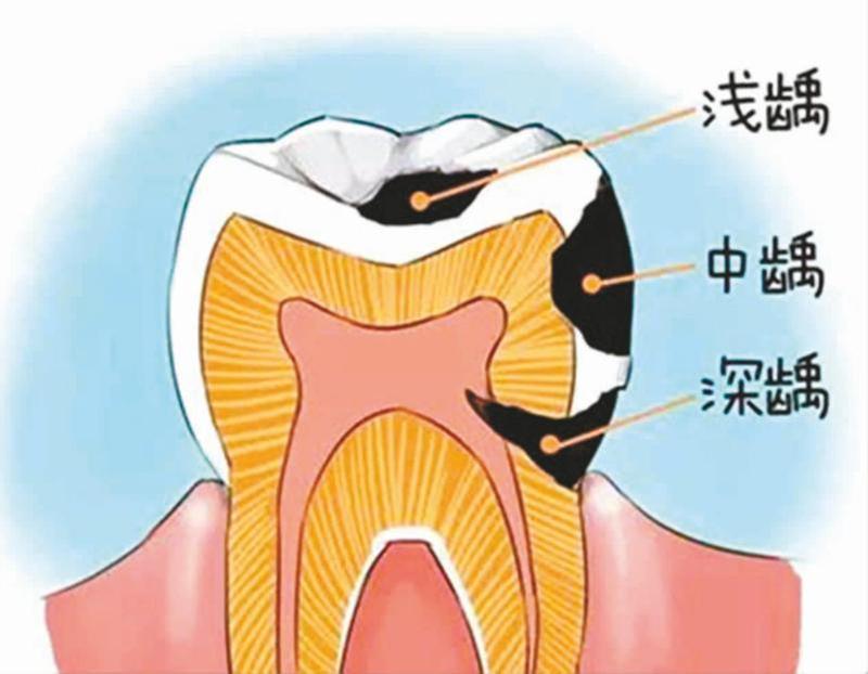 龋齿的预防知识