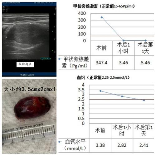 武胜县人民医院多学科联合成功开展全县首例“甲状旁腺腺瘤切除术”