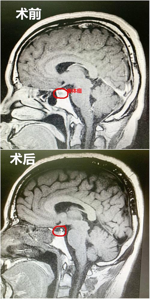 武胜县人民医院神经外科成功实施全县首例内镜下经鼻蝶垂体瘤切除术