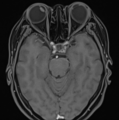宣汉县人民医院眼科团队成功治疗超高度近视伴固定性斜视患者