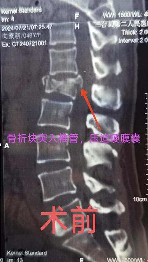 三台县芦溪镇中心卫生院成功开展首例经肌间隙入路脊柱骨折复位内固定+椎管造影术