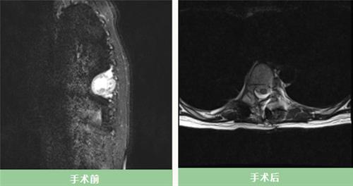 什邡市人民医院：警惕脊椎上的“隐形杀手”——椎管肿瘤