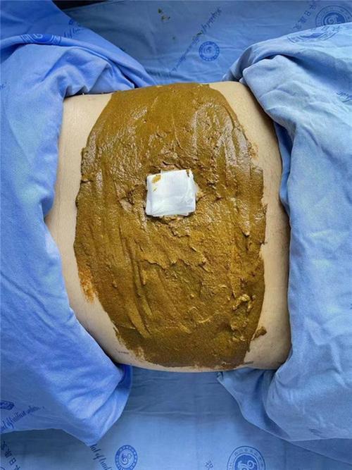 乐山市中医医院全力救治一胰腺炎患者